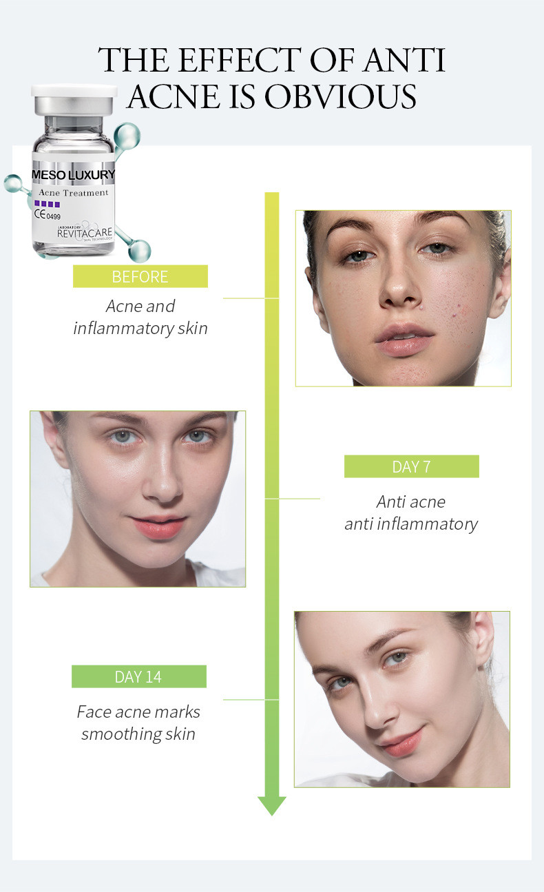 Pure Plant Pimple Clear Serum Whitening Treatment Mesotherapy For Acne Scars