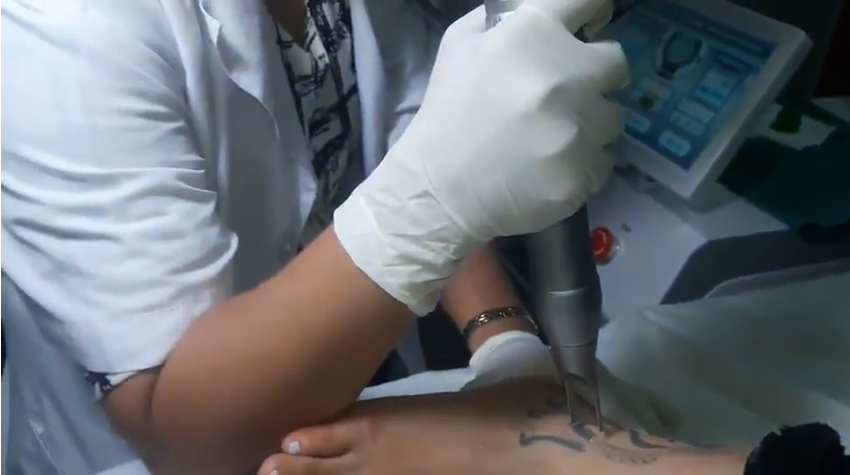 755, 650 1064nm q switched yag laser for hyperpigmentation nd yag laser system