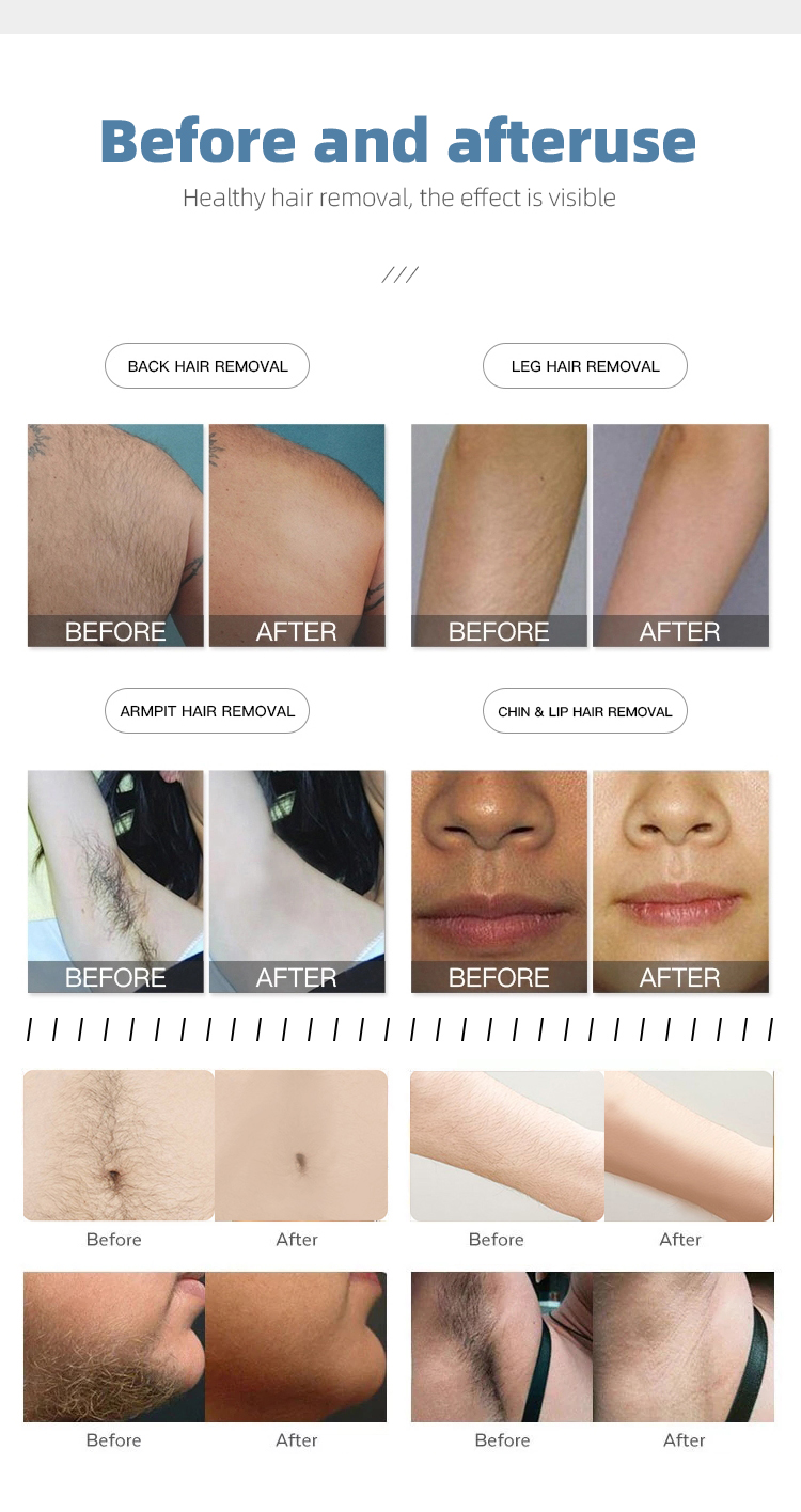 D1-2 808 diode laser hair removal machine professional tattoo removal device laser picosecond carbon peel machine