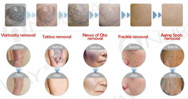1064nm 532 nm 1320nm Q Switched Nd Yag Laser Machine :Pigment removal,Tattoo