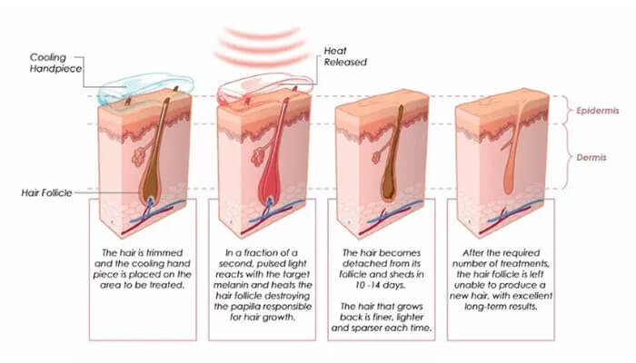 Portable Salon Use Shr Hair Removal Machine 3 In 1 Vertical