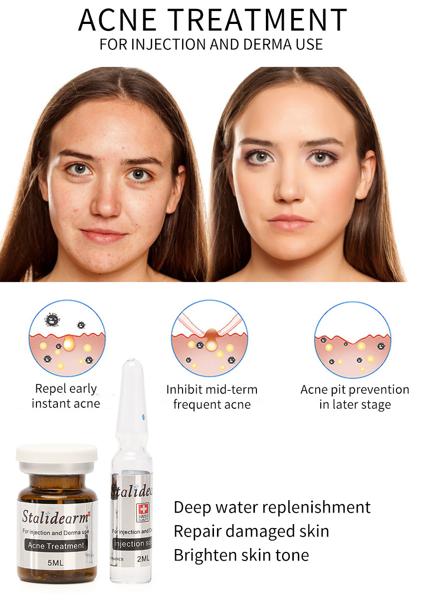 Stalidearm Acne Treatment Injection Serum Mesotherapy Nourishing No Side Effects