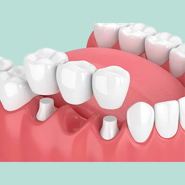 porcelain bridge Strong non-irritating Comfortable Strong Wear Resistance