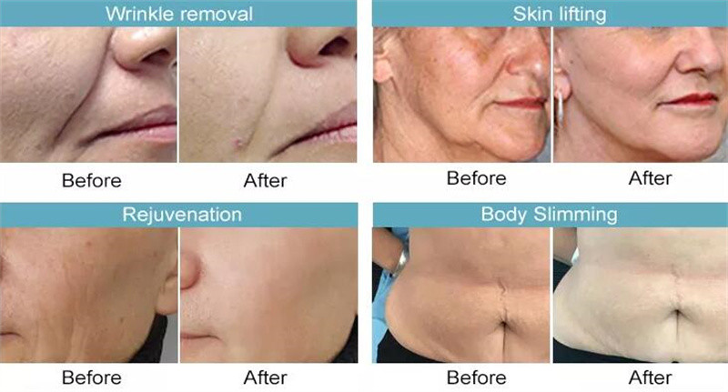 7d Hifu Equipment Portable Ultrasound Face Lifting Anti Wrinkle