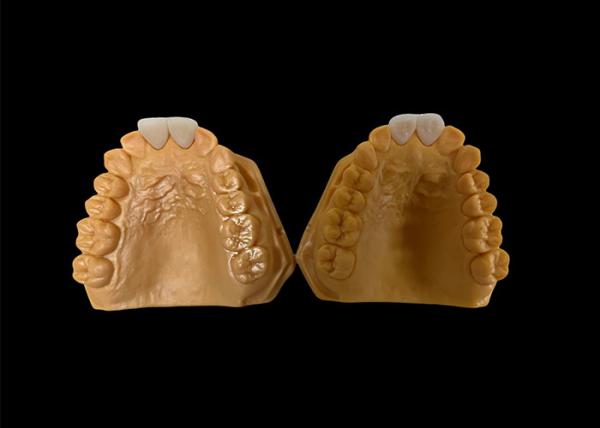 Customized Aesthetic Zirconia Dental Crown Perfectly Fitted for Anterior and
