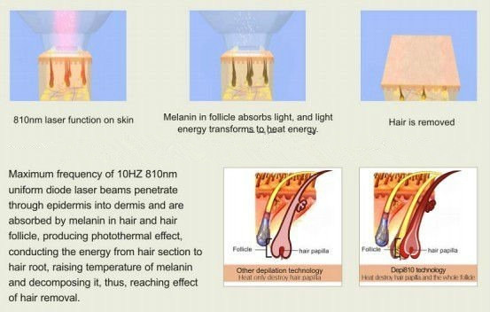 portable diode laser hair removal