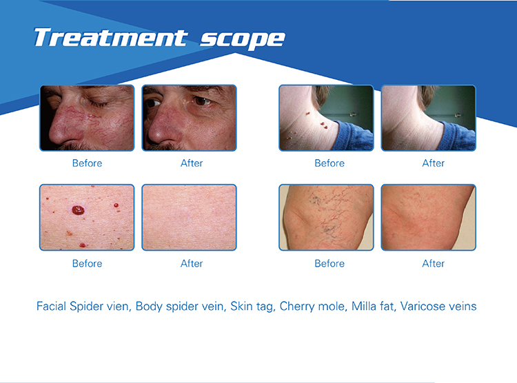 Painfree and Permanent 980nm laser diode laser hair removal machine