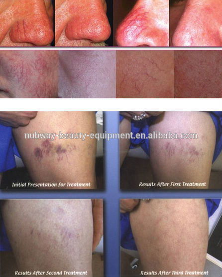 Factory direct sale healthy Spider Veins Facial Vascular Lesions Removal Machine