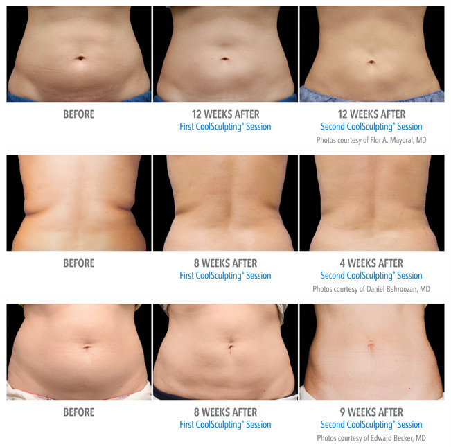 40k 5 In 1 5MHz Lipo Vacuum Slimming Machine
