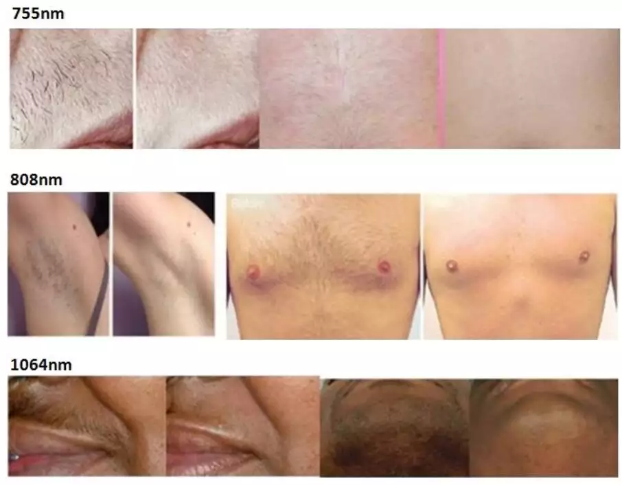 Style Portable 755nm 808nm 1064nm Wavelength Ice Diode Laser Mini Hair Removal Machine