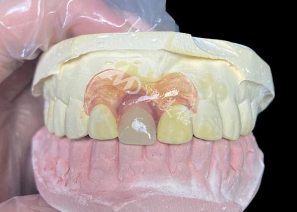 Nesbit flexible partial denture for incisors offering a seamless removable tooth