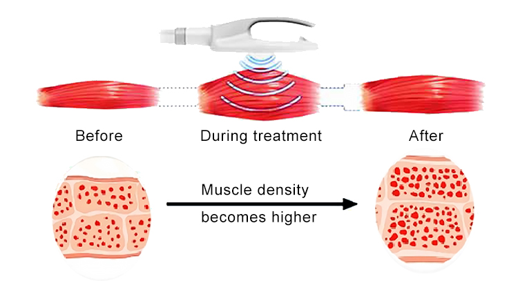 High Intensity Pulsed Electromagnetic Cavitation Slimming Machine Hiemt