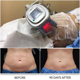 86 Kpa Ultrasonic Cryolipolysis Slimming Machine 360 Angle Surrounding