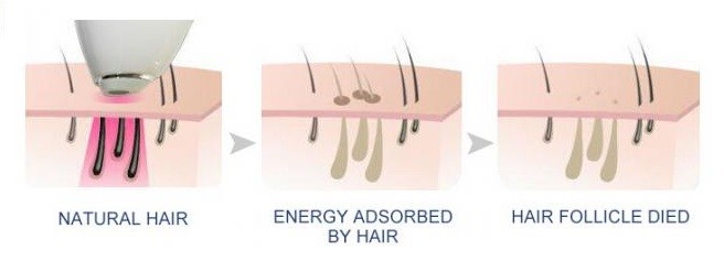 ICE Cooling Diode Laser Hair Removal Machine For Home 3 Wavelength 500W