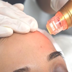 RF Microneedling â Treatments â Clinica Knightsbridge
