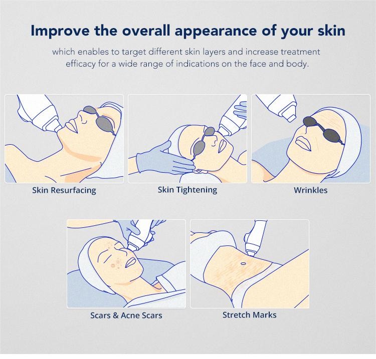 1550nm Diode Erbium Laser Machine Glass Fractional Laser Skin Resurfacing Equipment