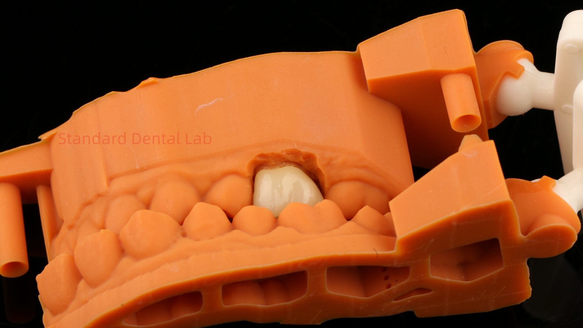 High Aesthetic Full Contour Zirconia Crown with Metal Post Core 5 Years Guarantee and Better Technicians from SDL Dental Lab
