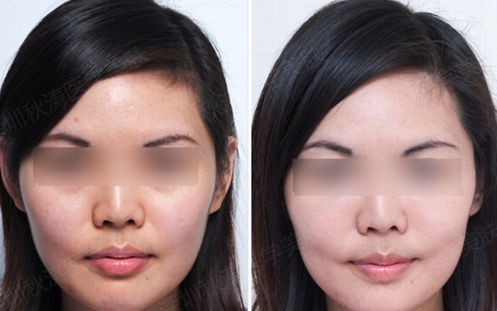 Whitening Youth Serum Injection Mesotherapy Skin Care Vitamin C Serum
