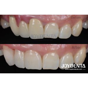  Painless Procedure BOPT Dental Technique for Accurate Tooth Preparation Manufactures