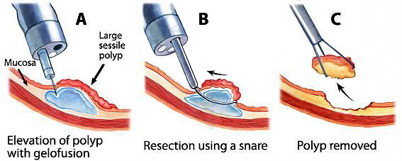 GM SD Single Use 2.3mm Polypectomy Snare For Polyp Cutting
