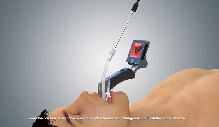 Difficult Airway Intubation Video Laryngoscope Continous Use 6h to Avoid COVID-19 Infection