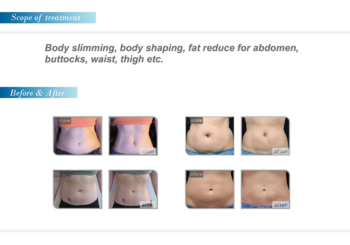 HOT SELLING!!! portable HIFUSHAPE SIMMING MACHINE FOR WEIGHT LOSS