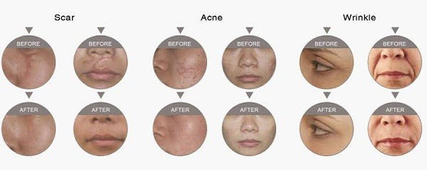 laser co2 fractional F5 Co2 Fractional Laser Machine For Scar / Wrinkle Removal 10600nm US imported RF tube fractional