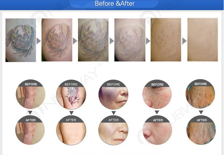 Freckles pigment age spots removal beauty machine FDA approved tattoo removal lasers