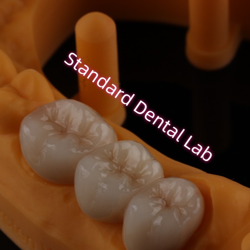 High Translucent PFZ Layered Zirconia Bridge Porcelain Ceramic Posterior