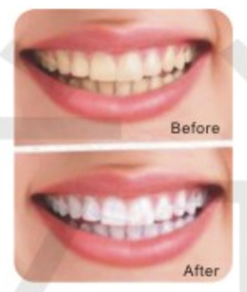 Teeth Whitening For Home Use Made In China Best Quality Whitening Kit