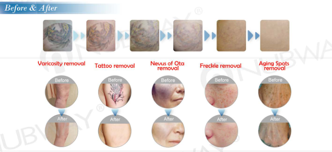 1064nm 532nm Q switch nd yag laser pulsed dye laser for tattoo removal vascular and skin rejuvenation