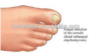 Medical nail fungus laser/ Long pulse nd yag laser 1064 nm onychomycosis