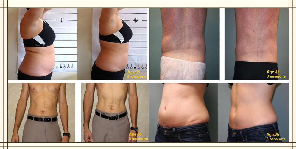 Nubway Lipo Laser Slimming Machine