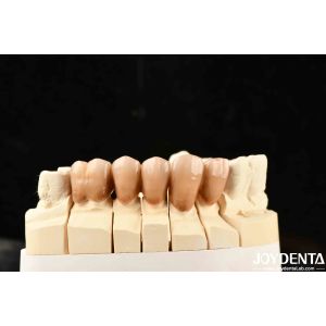 Bionic Development Leaves And Distinct Layers Of Zirconia All-Ceramic