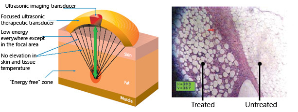 ultrasonic_lipolysis