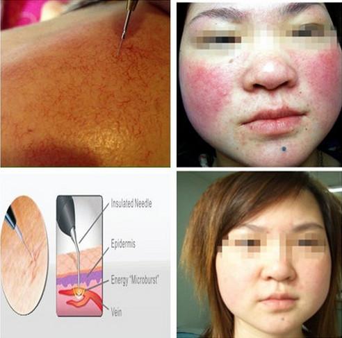Once Removed Spider Vein Removal / Facial Vein Removal