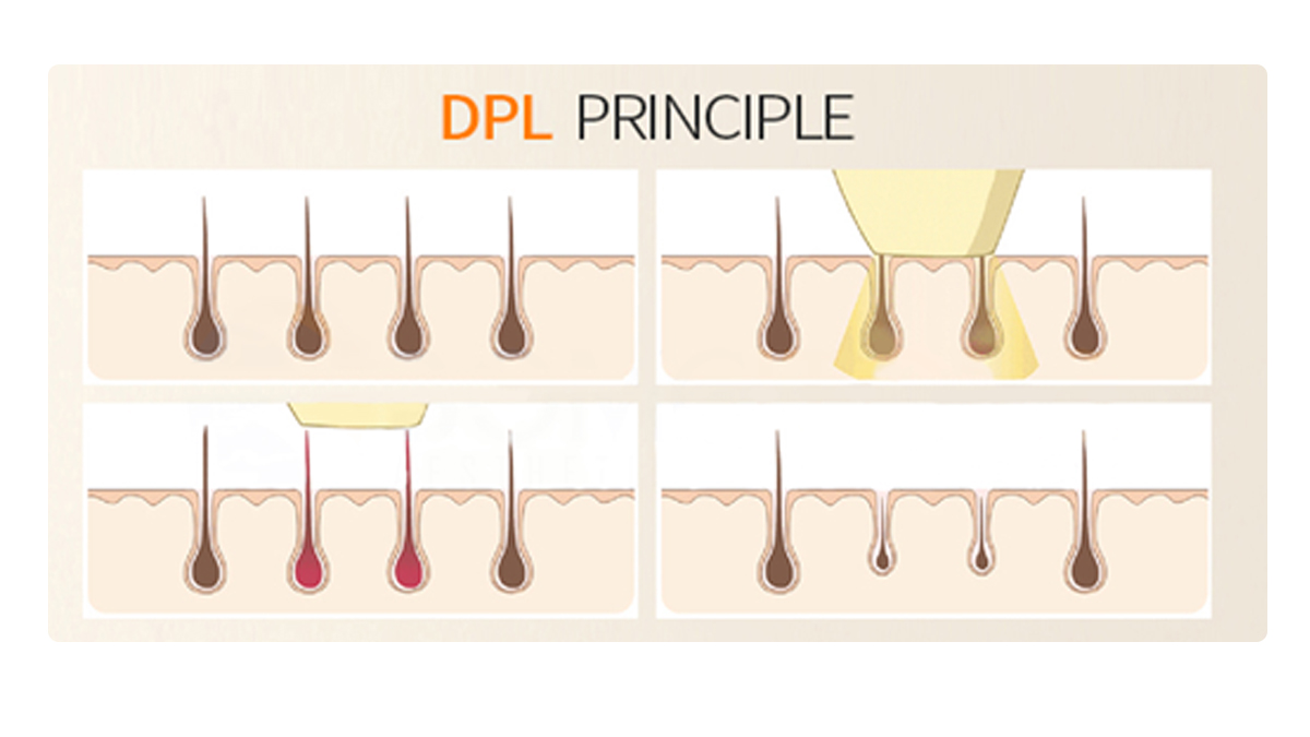 Professional Hair Removal Pigment Removal DPL Skin Rejuvenation Skin Tightening Laser Light Machine