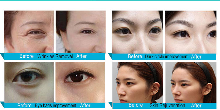 Face Lifting Eye Care Machine RF Skin Rejuvenation Device Skin Tightening