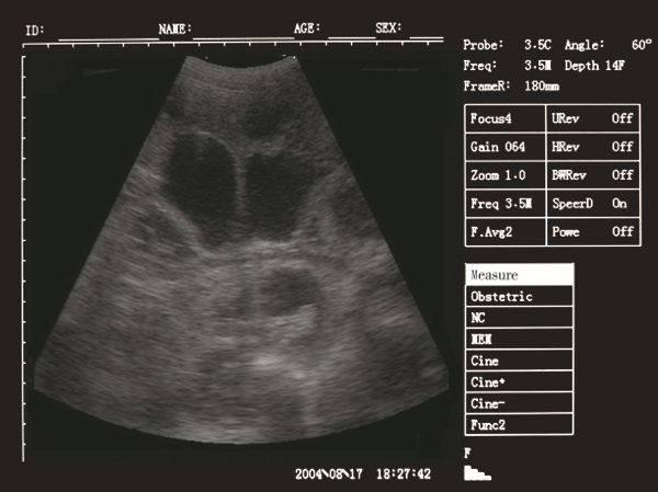 Palm Ultrasound ScannerSU-V5(ultrasonic,black white,Imaging System)