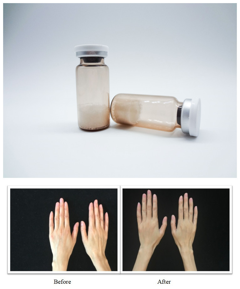 Injectable PLLA Hyaluronic Acid pCL PDRN Facial Dermal Filler For collagen production Wrinkle Treatment