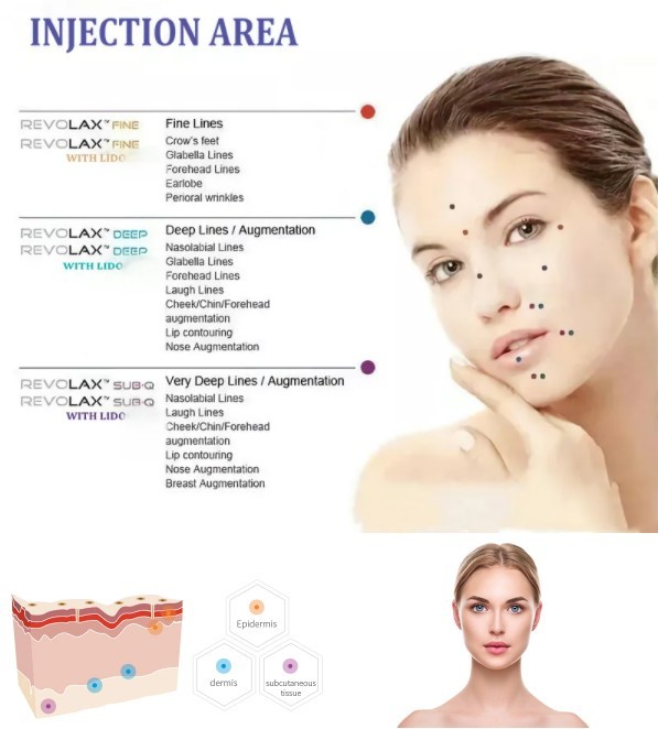 Injectable Revolax 1.1Ml HA Gel Dermal Filler Face Filling With Fine Deep And Sub -Q