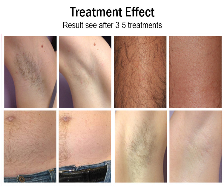 1800w Fiber Coupled Diode Laser Permanent Hair Removal Laser Machine