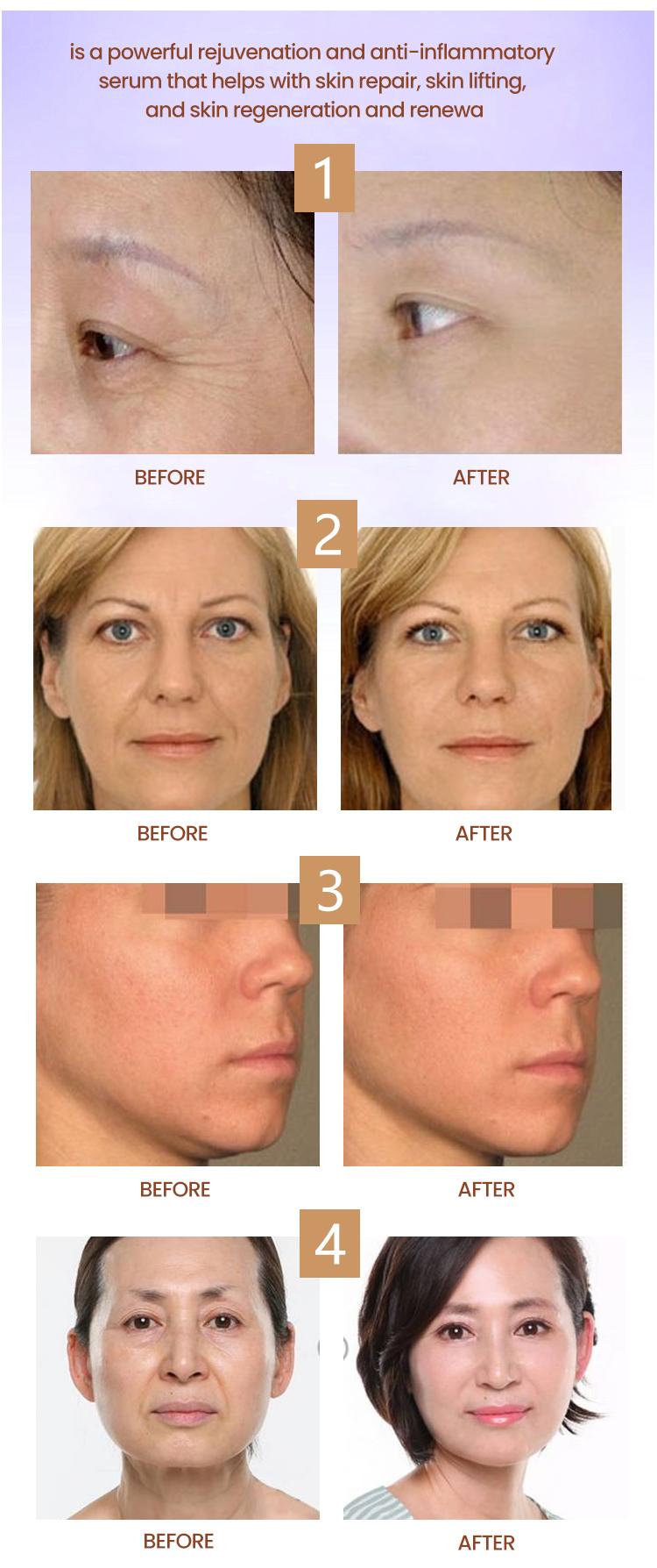 Anti Aging CYTOCARE 516 715 516 SKIN Care Juvderms Botulaxs 4ml 5ml