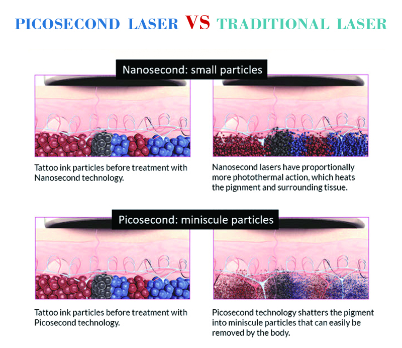 2018 trending products 755 laser picosure pigment removal