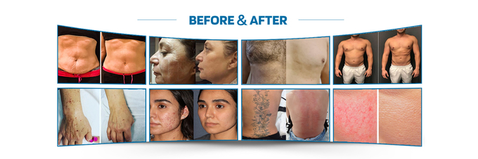 Vacuum 40k Rf Cavitation Machine Face Lifting Cavitation Skin Tightening Machine