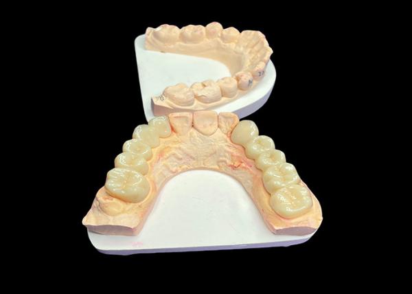 Natural Aesthetics Translucent Ceramic Crowns for Dental Restoration with Easy