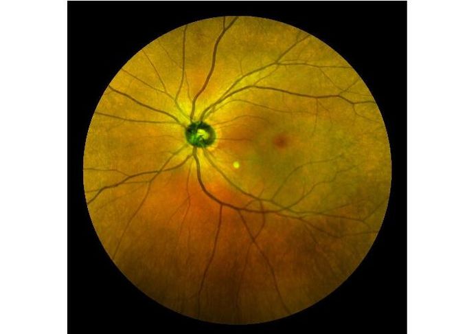 Ultra-wide Field Laser Scanning Retina Angiograph Digital Ophthalmic Equipment With Optical Zoom 100°/60°/30°