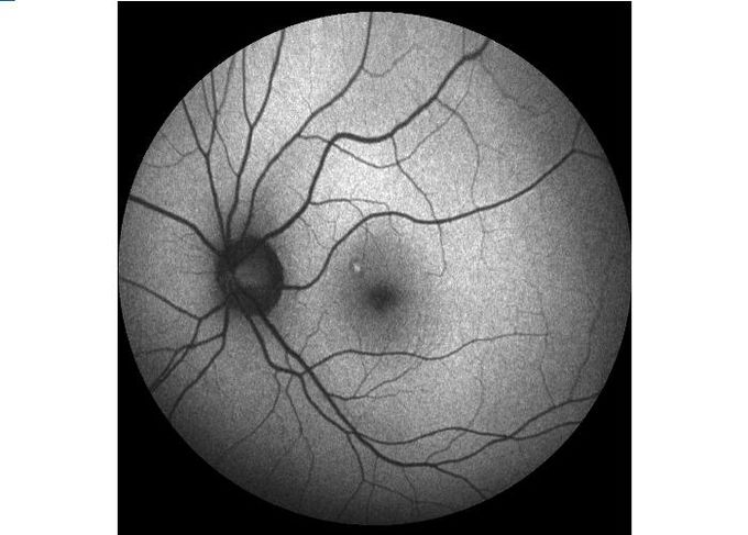 Ultra-wide Field Laser Scanning Retina Angiograph Digital Ophthalmic Equipment With Optical Zoom 100°/60°/30°