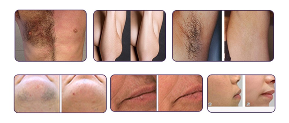 Three Wavelengths Diode Laser Hair Removal Machine 1 - 10Hz Frequency