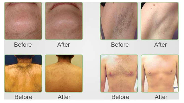 Medical Spa Aesthetic Laser Machine / SDL-B Diode Laser Hair Removal Equipment